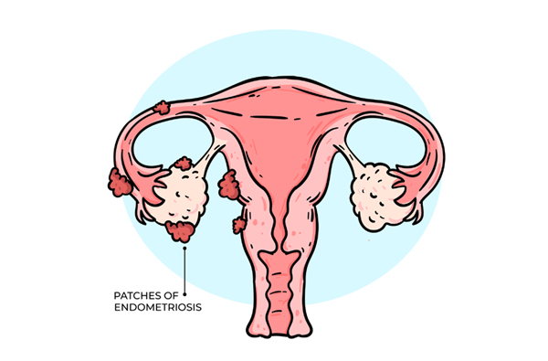 Endometriosis
