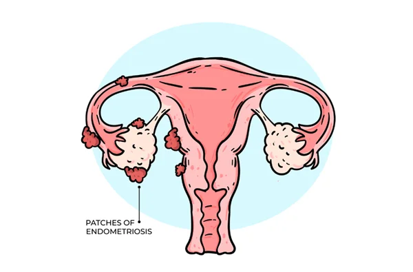 Endometriosis