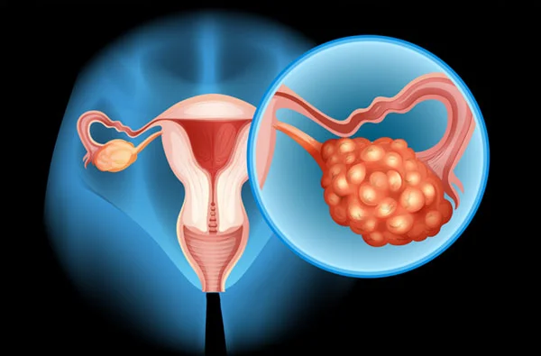 Ovarian Cysts
