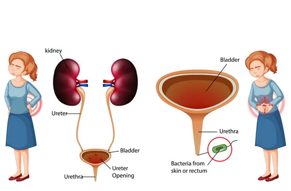 Urinary Tract Infections