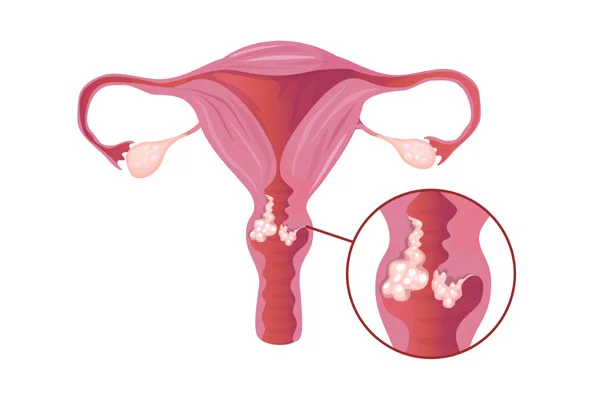 Cervical Cancer and Vaccinations